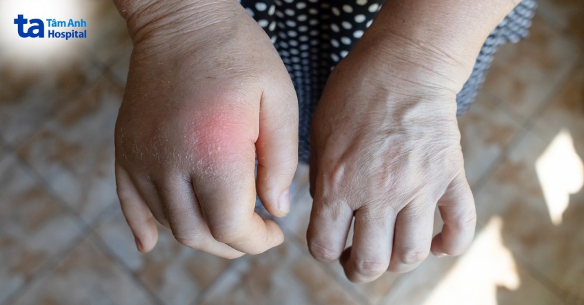 triệu chứng viêm cầu thận tăng sinh màng