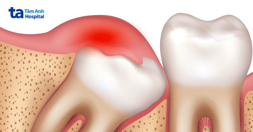 Triệu chứng viêm lợi trùm răng khôn