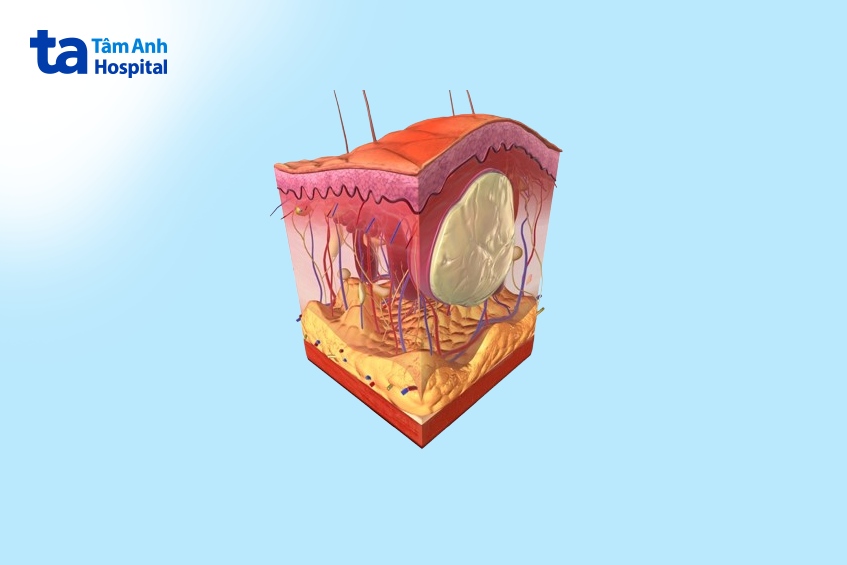 u bã đậu ở mông chứa đầy chất lỏng dưới bề mặt da