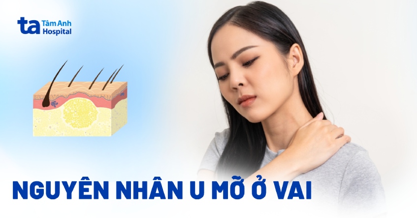 U mỡ ở vai có nguy hiểm không? Nguyên nhân, dấu hiệu, điều trị