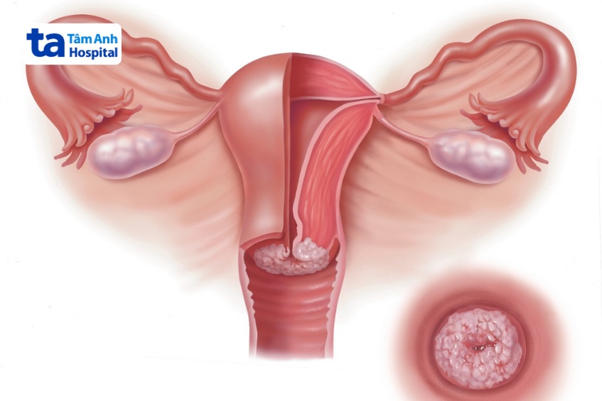 ung thư cổ tử cung liên quan hpv type 16 và 18