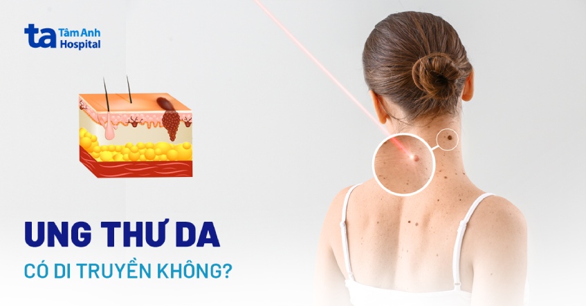 Ung thư da có di truyền không? Có bị ảnh hưởng bởi gen?