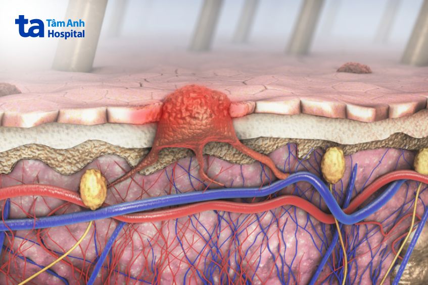 Ung thư da di căn bằng cách xâm nhập hệ thống mạch máu và mạch bạch huyết
