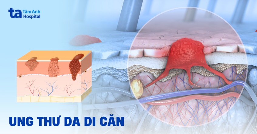 Ung thư da di căn có chữa được không? Triệu chứng và điều trị