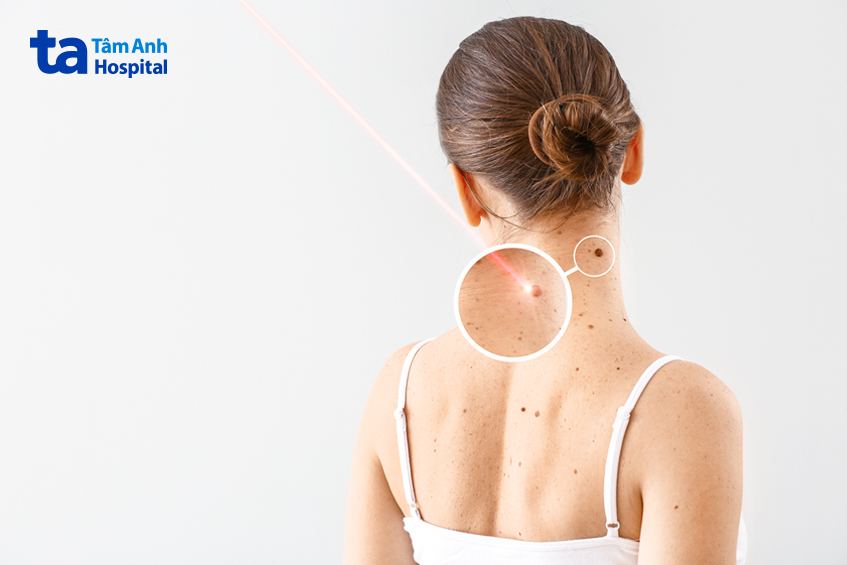 Ung thư da không tế bào hắc tố và ung thư tế bào hắc tố