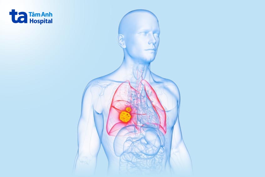 ung thư phổi có chữa khỏi được không