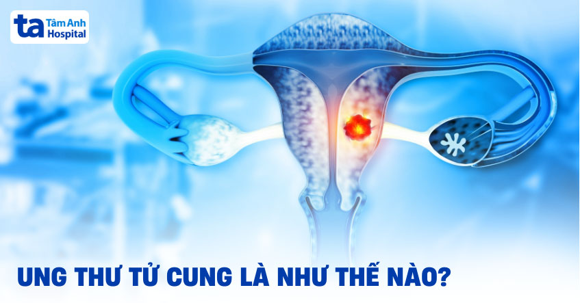 ung thư tử cung
