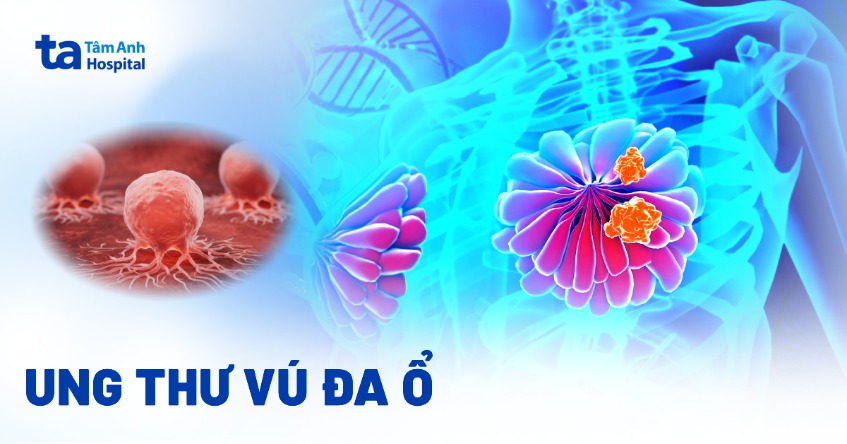 Ung thư vú đa ổ (MF) là gì? Triệu chứng, chẩn đoán và tiên lượng