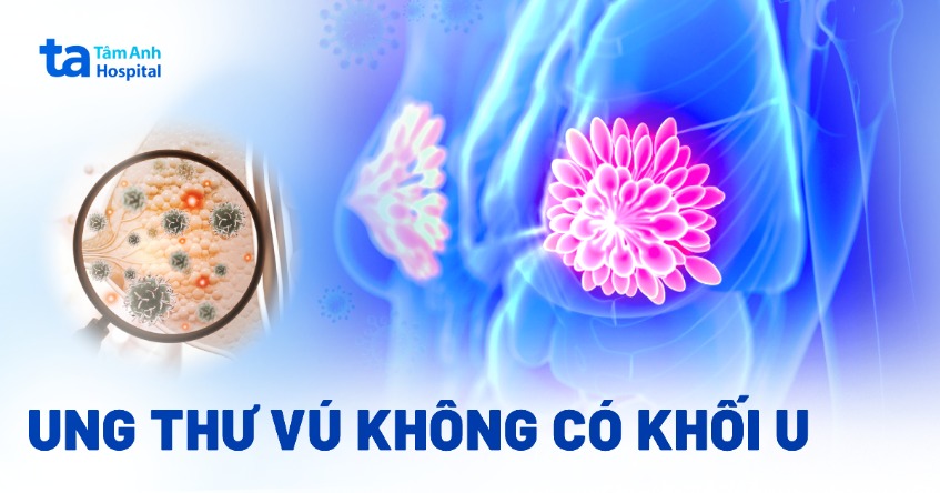 ung thư vú không có khối u
