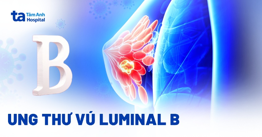 Ung thư vú luminal B: Triệu chứng, chẩn đoán và cách điều trị