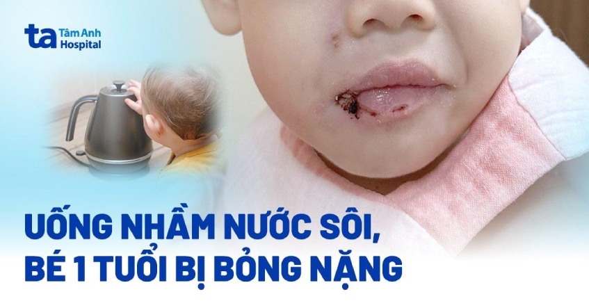 Uống nhầm nước sôi, bé 1 tuổi bị bỏng nặng