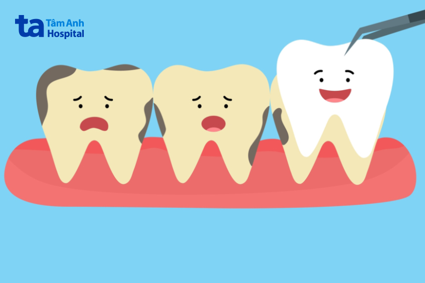 Cách làm trắng răng bị ố vàng