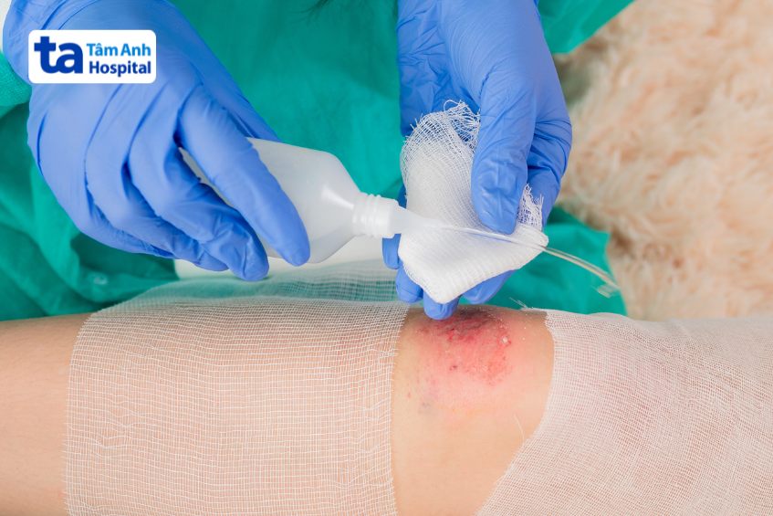 Vệ sinh vết bỏng đúng cách để loại bỏ dịch, mủ, tế bào chết
