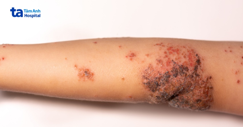 viêm cầu thận có nguyên nhân do bệnh lở