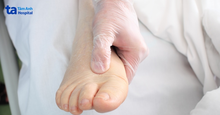 viêm cầu thận gây phù nề do giữ nước