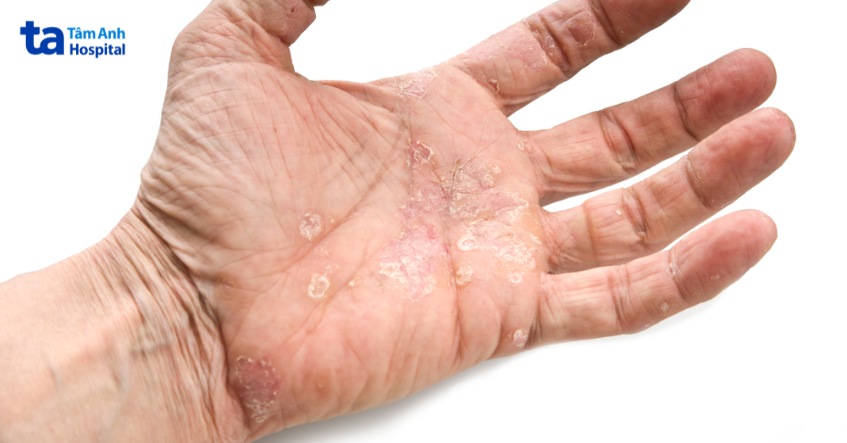 viêm da cơ địa lòng bàn tay