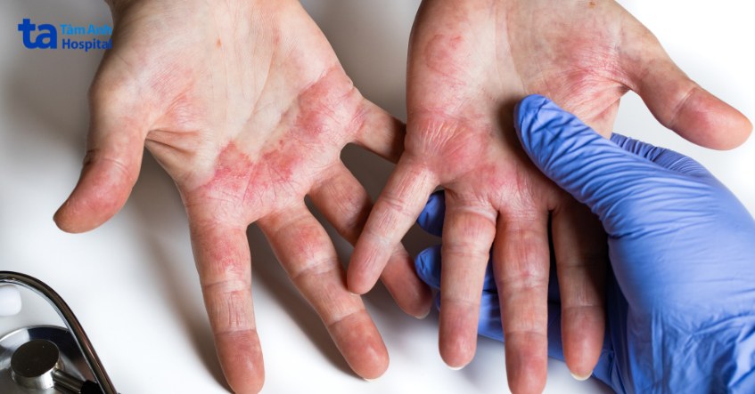 viêm da cơ địa ở bàn tay