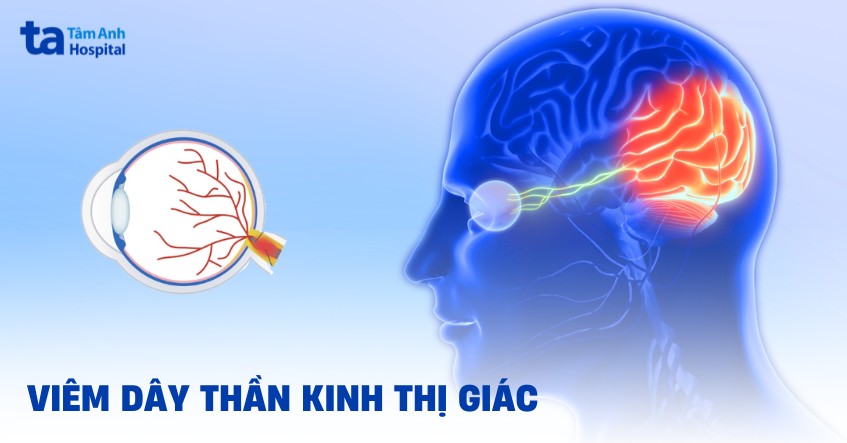 viêm dây thần kinh thị giác