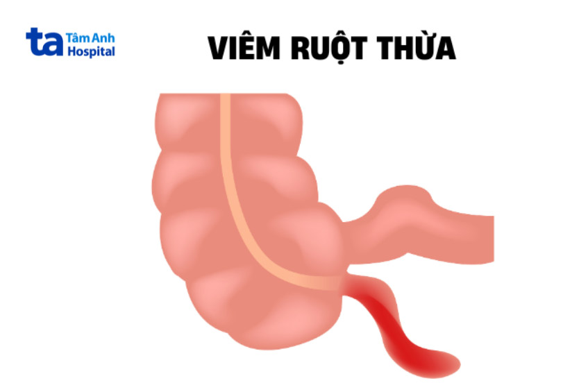 Viêm ruột thừa là viêm ở phần ruột nhỏ nối ruột già