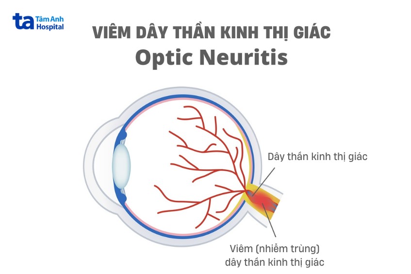viêm thần kinh thị giác có thể bị ở 2 mắt