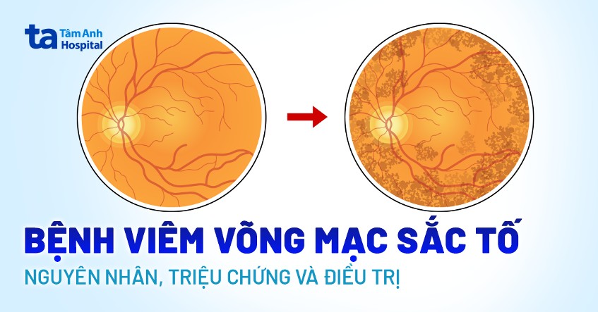 viêm võng mạc sắc tố