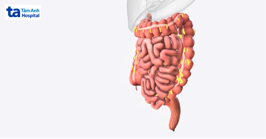 viêm xơ hóa mạc treo