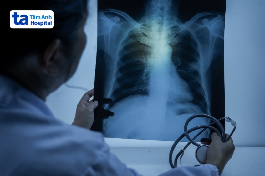 x quang xương sườn