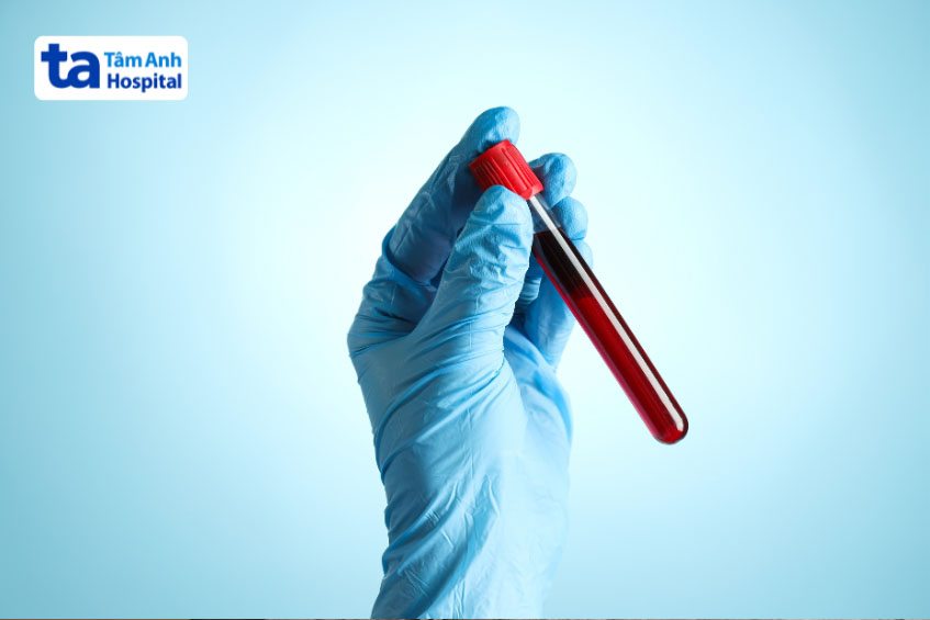 Xét nghiệm máu tìm nguyên nhân khớp háng kêu