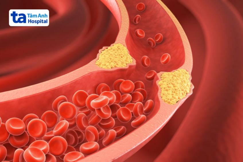 Xơ vữa động mạch