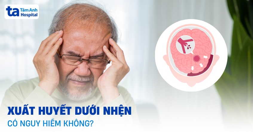 Xuất huyết dưới nhện có nguy hiểm không? Ảnh hưởng sức khỏe ra sao?