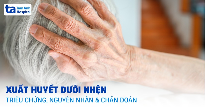 Xuất huyết dưới nhện: Triệu chứng, nguyên nhân, cách chẩn đoán