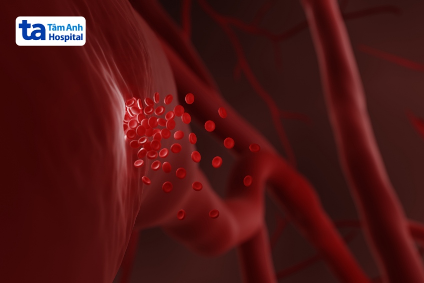 xuất huyết não ở người trẻ là dạng đột quỵ nguy hiểm