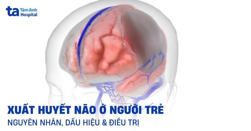 Xuất huyết não ở người trẻ: Nguyên nhân, dấu hiệu và cách điều trị