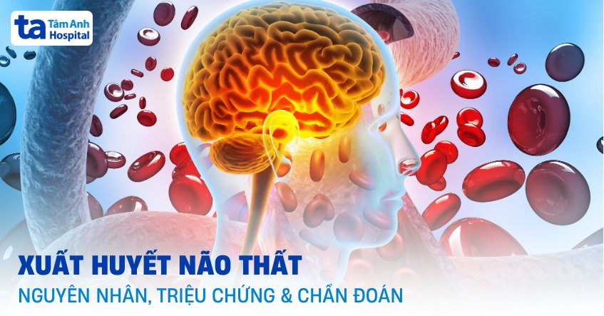 Xuất huyết não thất: Nguyên nhân, triệu chứng và cách chẩn đoán