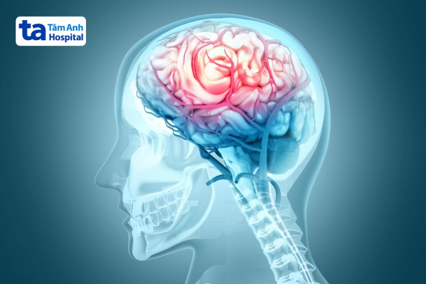 xuất huyết não xảy ra khi mạch máu não bị vỡ