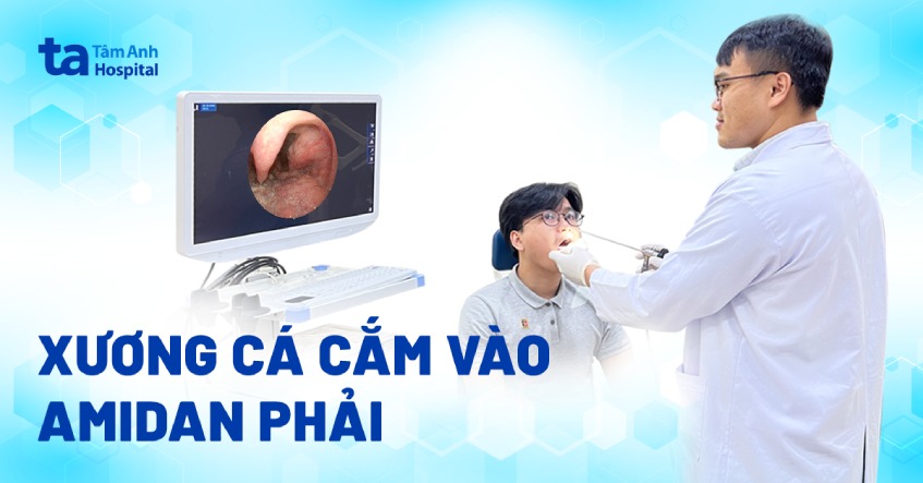 xương cá cấm vào amidan phải