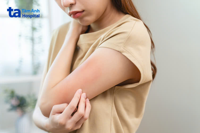 allopurinol gây phát ban trên da