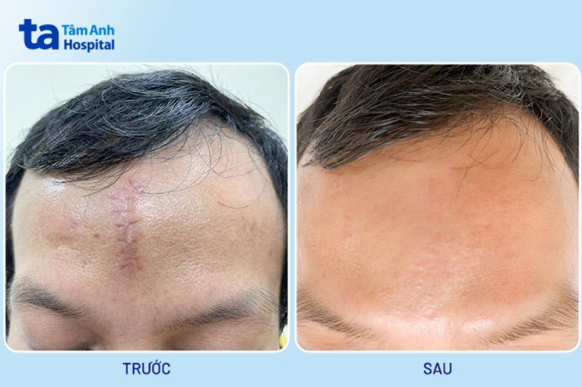 ảnh bệnh nhân trước và sau khi xóa sẹo