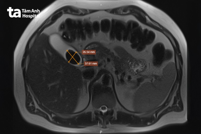 ảnh mri túi mật chứa sỏi