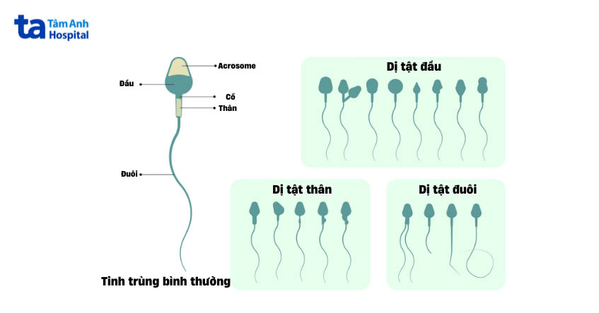 tinh trùng dị dạng có con được không