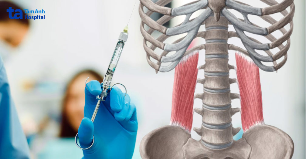 Bác sĩ đưa kim đến đúng vị trí cơ vuông thắt lưng để đưa thuốc tê vào, gây tê cục bộ vùng mục tiêu