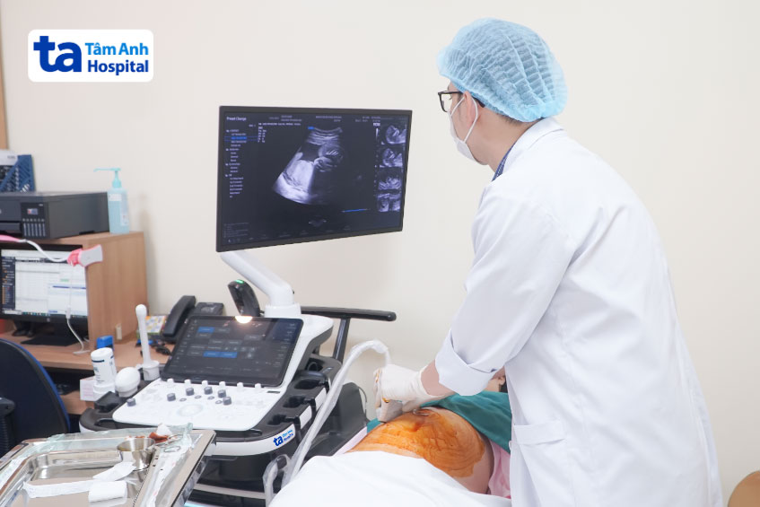 bác sĩ hưng chọc ối cho thai phụ