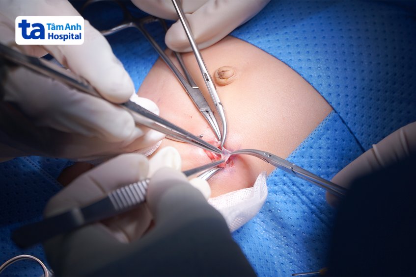 Bác sĩ Trọng cột cắt túi thoát vị bẹn cho bé Lập