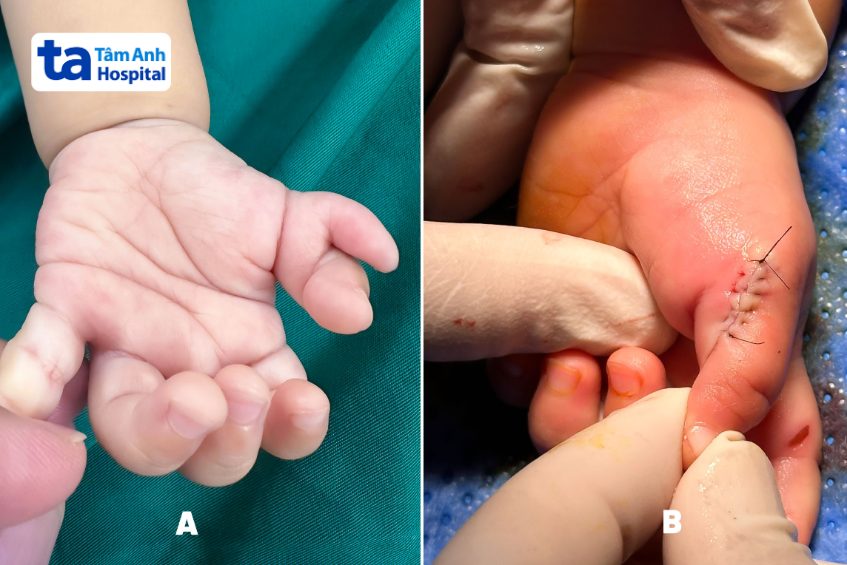 Bàn tay trái của Trang Anh trước và sau phẫu thuật