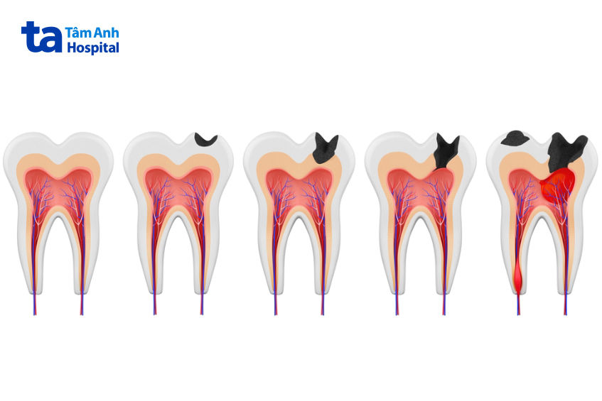 Nguyên nhân gây viêm tủy răng ở trẻ em