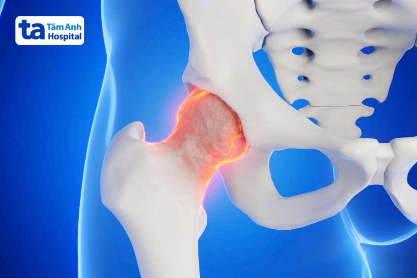 Bệnh loạn sạn khớp háng trẻ em