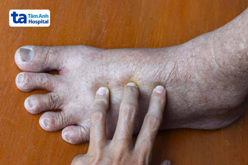 Bệnh nhân bị phù thũng ở chân