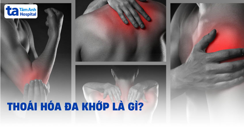 Bệnh thoái hóa khớp là gì?