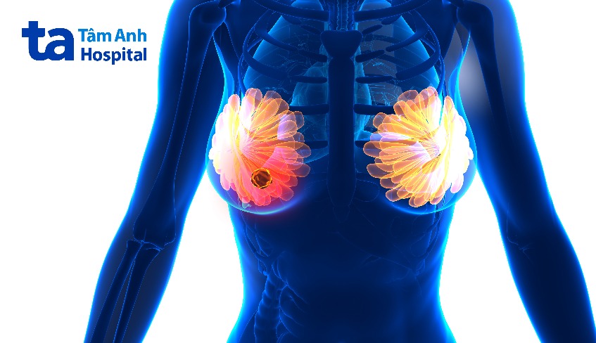 bệnh u tuyến vú