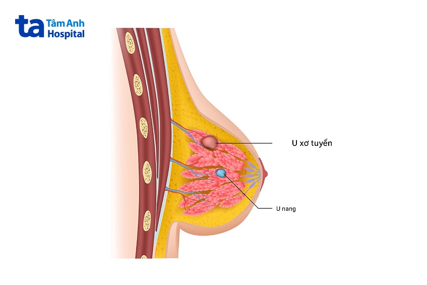 bệnh u xơ tuyến vú có nguy hiểm không